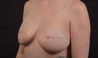 Reconstructive Breast Revision Before & After Gallery - Patient 137861 - Image 8
