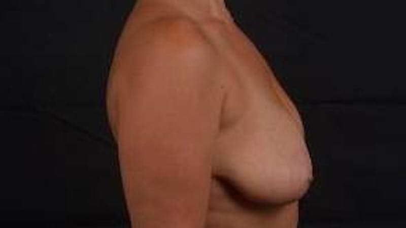 Mastopexy Before & After Gallery - Patient 288121 - Image 5