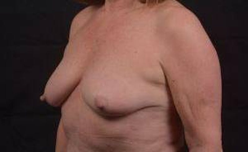 Immediate Breast Reconstruction – Skin Sparing Before & After Gallery - Patient 498308 - Image 7