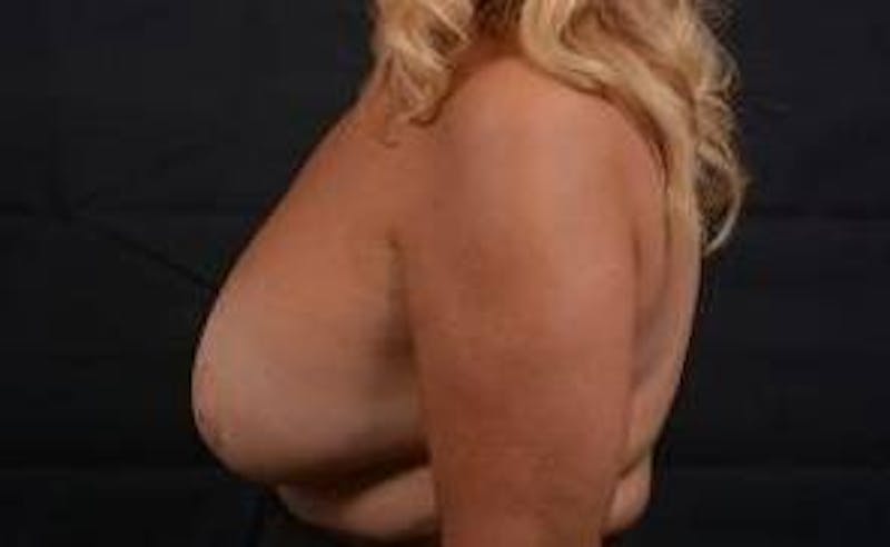 Aesthetic Breast Revision Before & After Gallery - Patient 198859 - Image 3