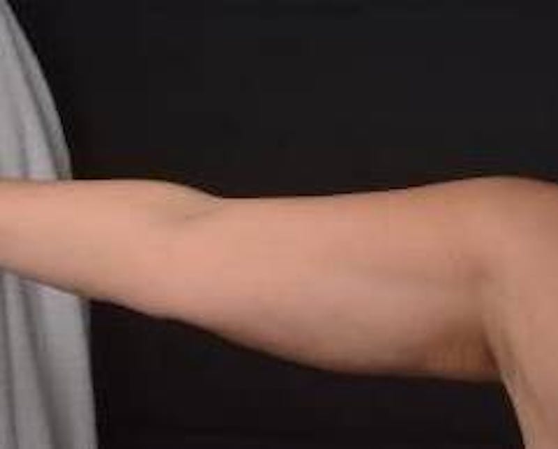 BodyTite Arms Before & After Gallery - Patient 400319 - Image 3