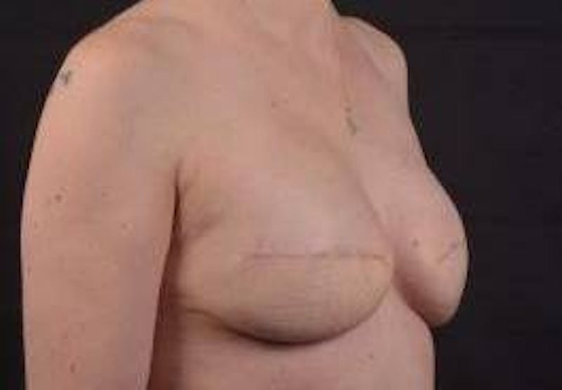 Reconstructive Breast Revision Before & After Gallery - Patient 137861 - Image 9