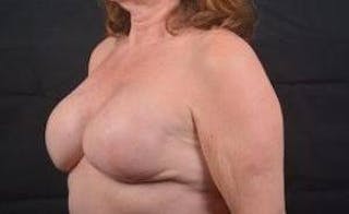 Immediate Breast Reconstruction – Skin Sparing Before & After Gallery - Patient 498308 - Image 8