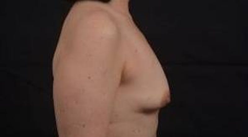 Immediate Breast Reconstruction – Nipple Sparing Before & After Gallery - Patient 133183 - Image 5