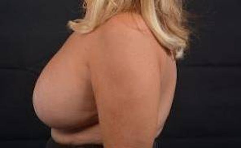 Aesthetic Breast Revision Before & After Gallery - Patient 198859 - Image 4