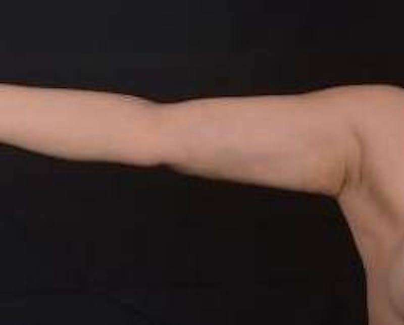 BodyTite Arms Before & After Gallery - Patient 400319 - Image 4