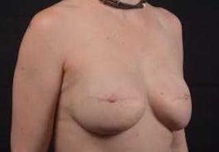 Reconstructive Breast Revision Before & After Gallery - Patient 137861 - Image 10
