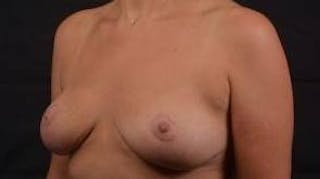 Mastopexy Before & After Gallery - Patient 288121 - Image 8