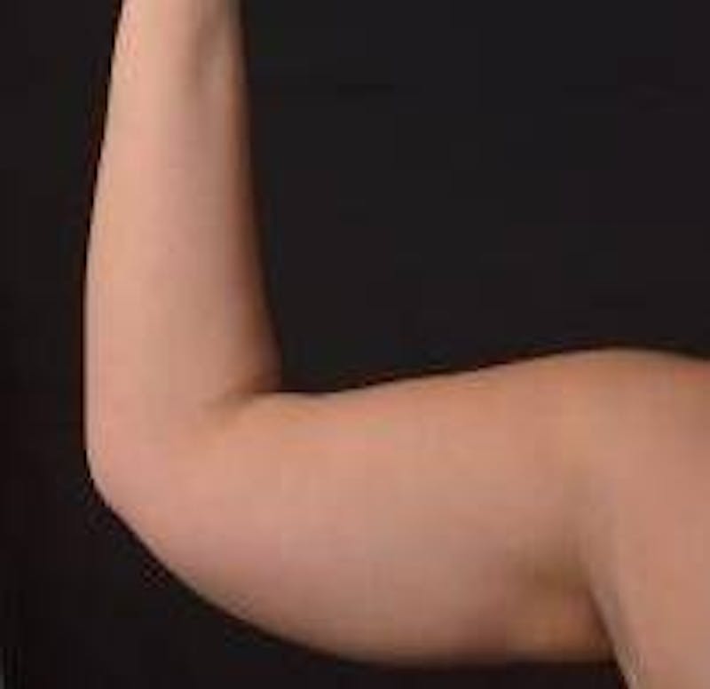 BodyTite Arms Before & After Gallery - Patient 400319 - Image 5