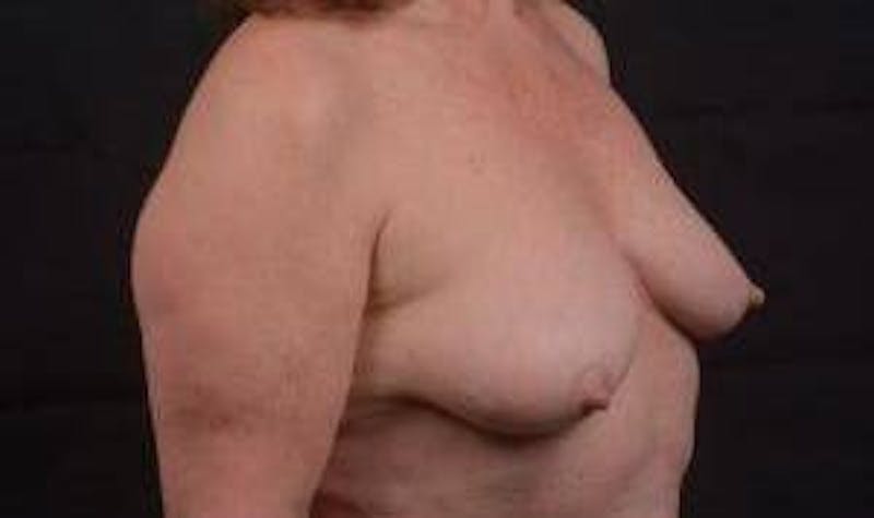 Immediate Breast Reconstruction – Skin Sparing Before & After Gallery - Patient 498308 - Image 9
