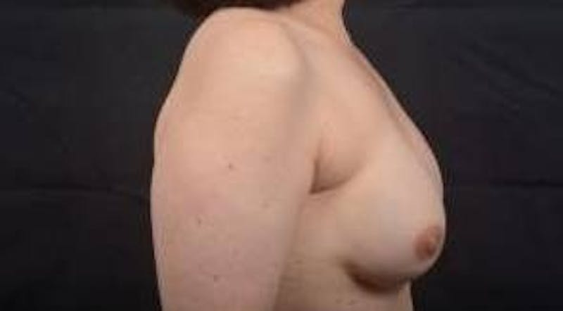 Immediate Breast Reconstruction – Nipple Sparing Before & After Gallery - Patient 133183 - Image 6