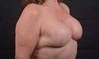 Immediate Breast Reconstruction – Skin Sparing Before & After Gallery - Patient 498308 - Image 10