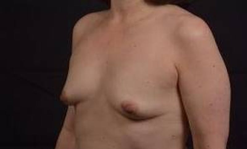 Immediate Breast Reconstruction – Nipple Sparing Before & After Gallery - Patient 133183 - Image 7