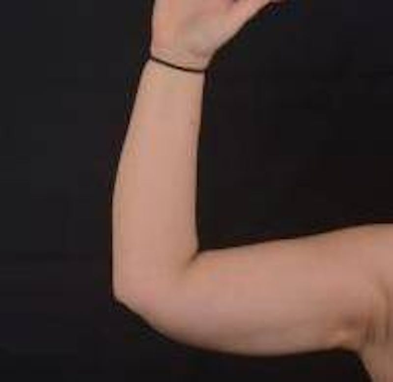 BodyTite Arms Before & After Gallery - Patient 400319 - Image 6