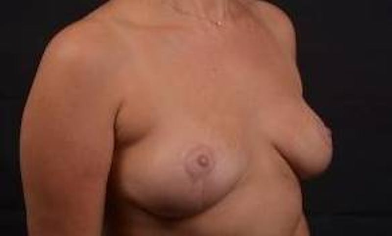 Mastopexy Before & After Gallery - Patient 288121 - Image 10