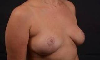 Mastopexy Before & After Gallery - Patient 288121 - Image 10