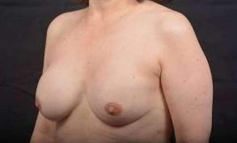 Immediate Breast Reconstruction – Nipple Sparing Before & After Gallery - Patient 133183 - Image 8