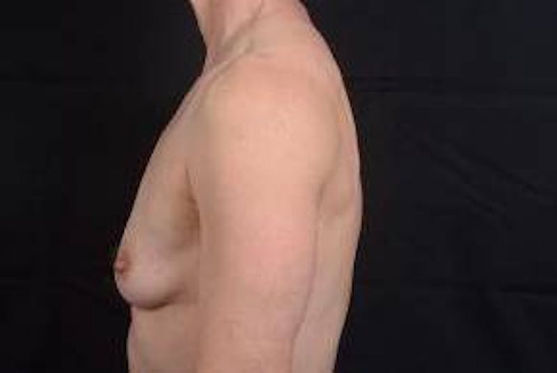 Immediate Breast Reconstruction – Skin Sparing Before & After Gallery - Patient 871817 - Image 3