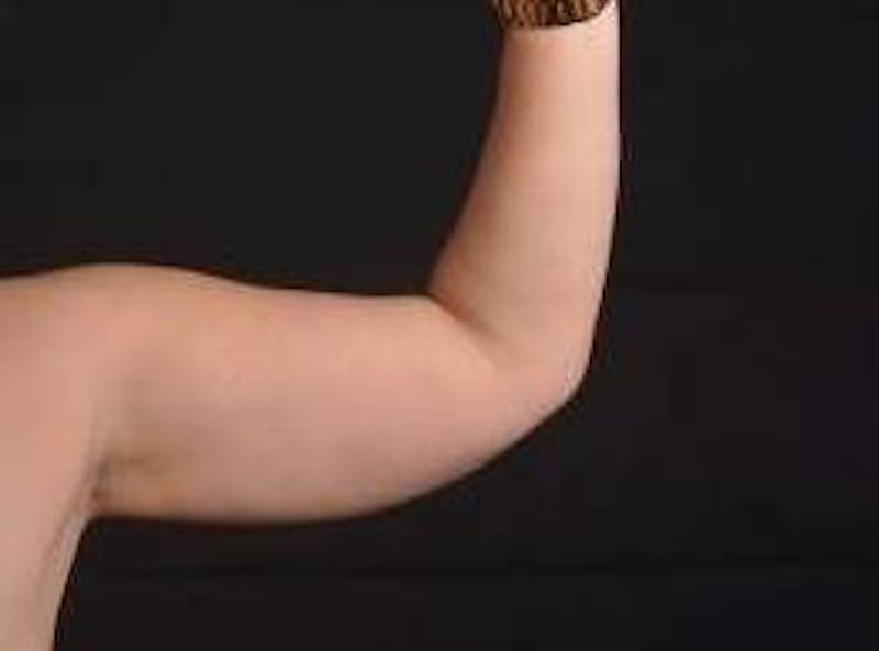 BodyTite Arms Before & After Gallery - Patient 400319 - Image 7