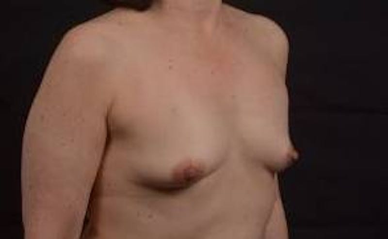 Immediate Breast Reconstruction – Nipple Sparing Before & After Gallery - Patient 133183 - Image 9