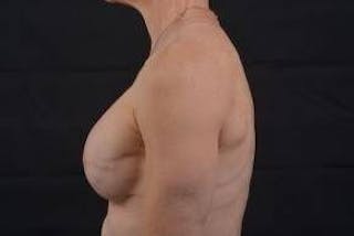 Immediate Breast Reconstruction – Skin Sparing Before & After Gallery - Patient 871817 - Image 4