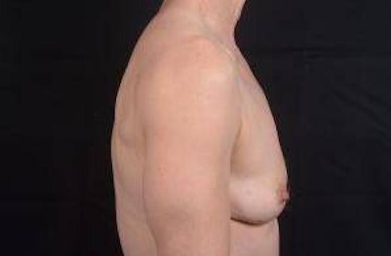 Immediate Breast Reconstruction – Skin Sparing Before & After Gallery - Patient 871817 - Image 5