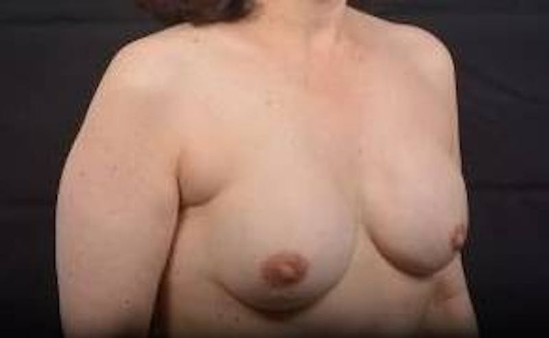 Immediate Breast Reconstruction – Nipple Sparing Before & After Gallery - Patient 133183 - Image 10