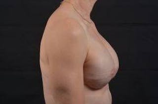 Immediate Breast Reconstruction – Skin Sparing Before & After Gallery - Patient 871817 - Image 6