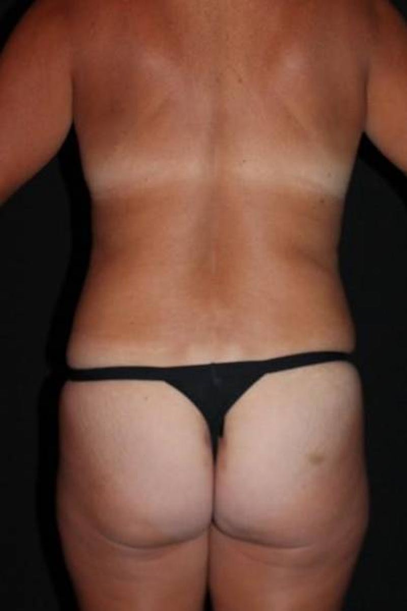 360 Liposuction Before & After Gallery - Patient 143944 - Image 11
