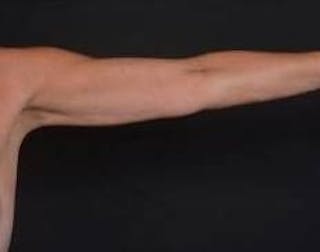 BodyTite Arms Before & After Gallery - Patient 386112 - Image 4