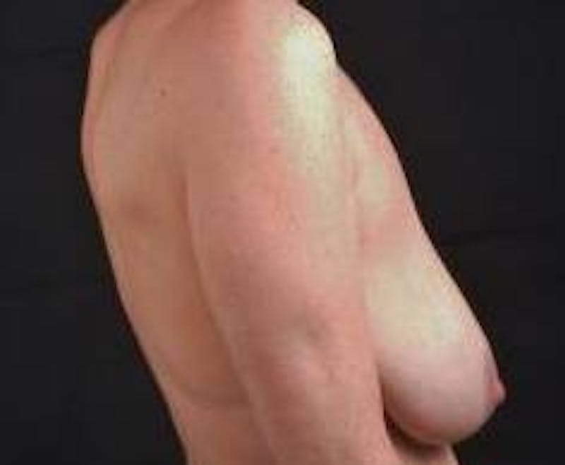 Mastopexy Before & After Gallery - Patient 159407 - Image 5