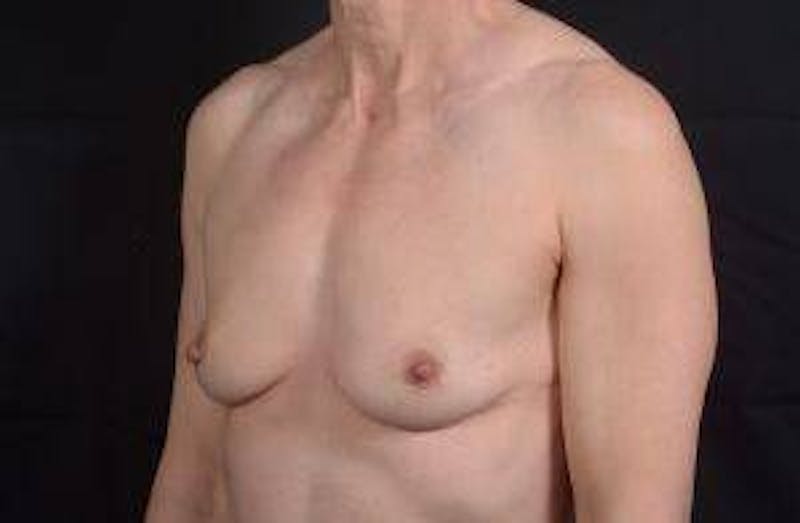 Immediate Breast Reconstruction – Skin Sparing Before & After Gallery - Patient 871817 - Image 7