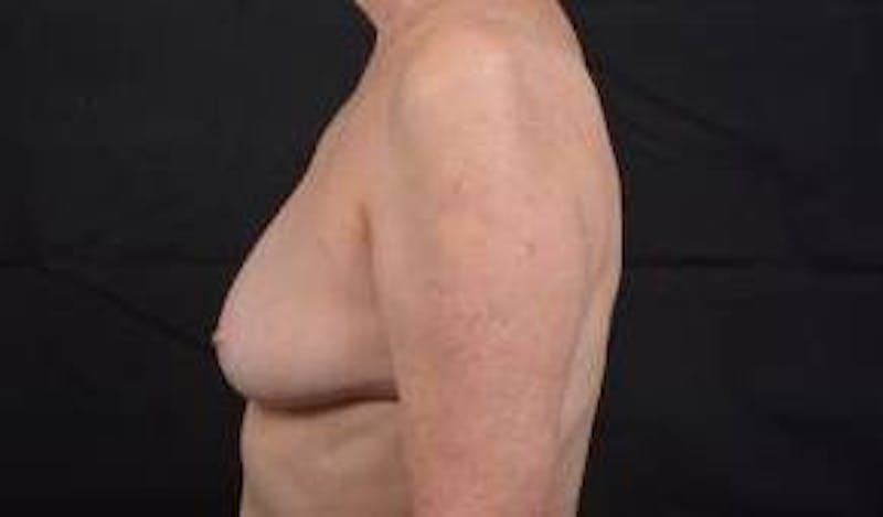 Immediate Breast Reconstruction – Nipple Sparing Before & After Gallery - Patient 351464 - Image 3