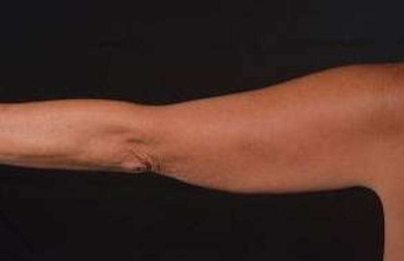 BodyTite Arms Before & After Gallery - Patient 386112 - Image 5