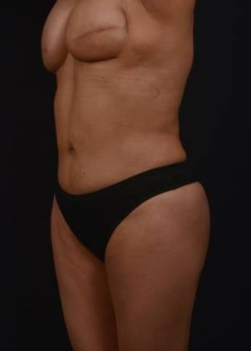 Brazillian Butt Lift Before & After Gallery - Patient 209829 - Image 4