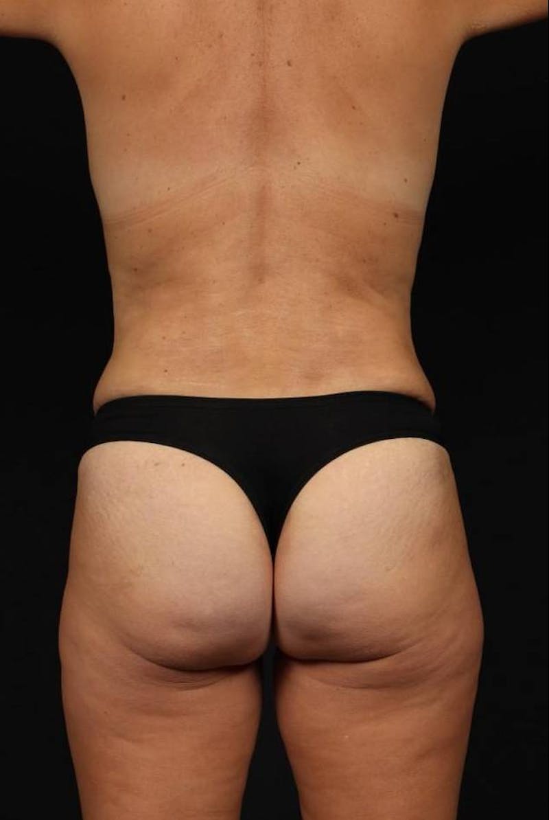 360 Liposuction Before & After Gallery - Patient 143944 - Image 12