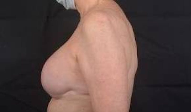 Immediate Breast Reconstruction – Nipple Sparing Before & After Gallery - Patient 351464 - Image 4