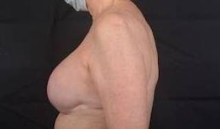 Immediate Breast Reconstruction – Nipple Sparing Before & After Gallery - Patient 351464 - Image 4