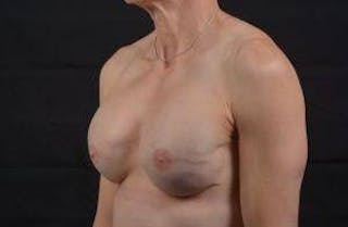 Immediate Breast Reconstruction – Skin Sparing Before & After Gallery - Patient 871817 - Image 8