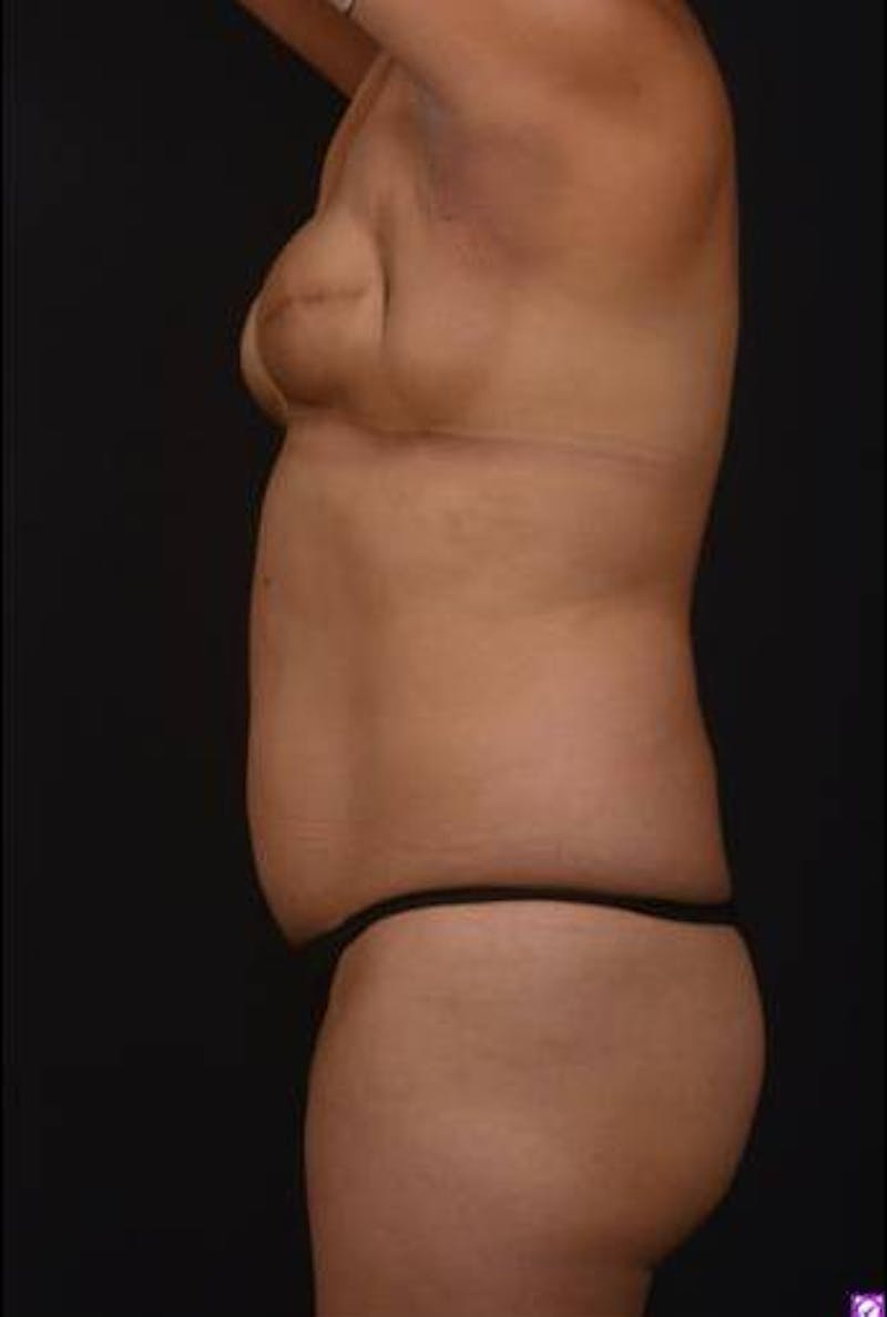 Brazillian Butt Lift Before & After Gallery - Patient 209829 - Image 5
