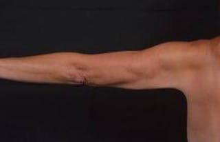 BodyTite Arms Before & After Gallery - Patient 386112 - Image 6
