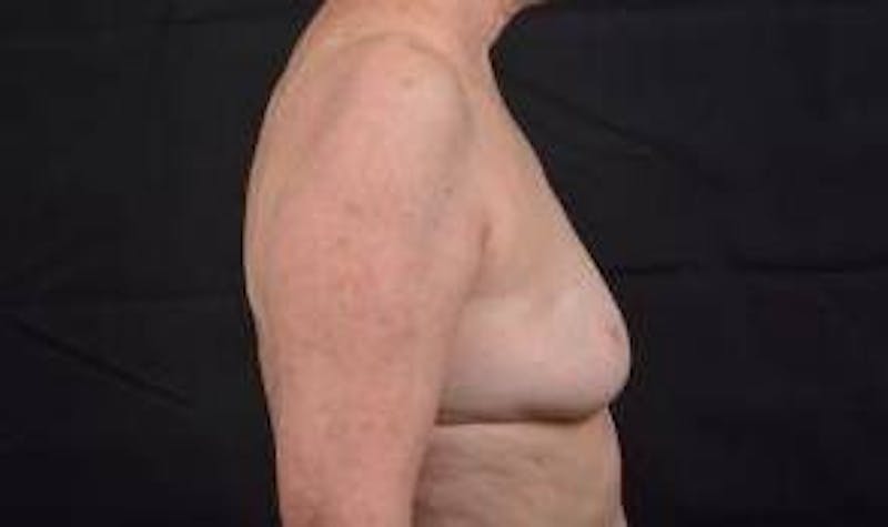 Immediate Breast Reconstruction – Nipple Sparing Before & After Gallery - Patient 351464 - Image 5