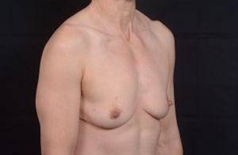 Immediate Breast Reconstruction – Skin Sparing Before & After Gallery - Patient 871817 - Image 9