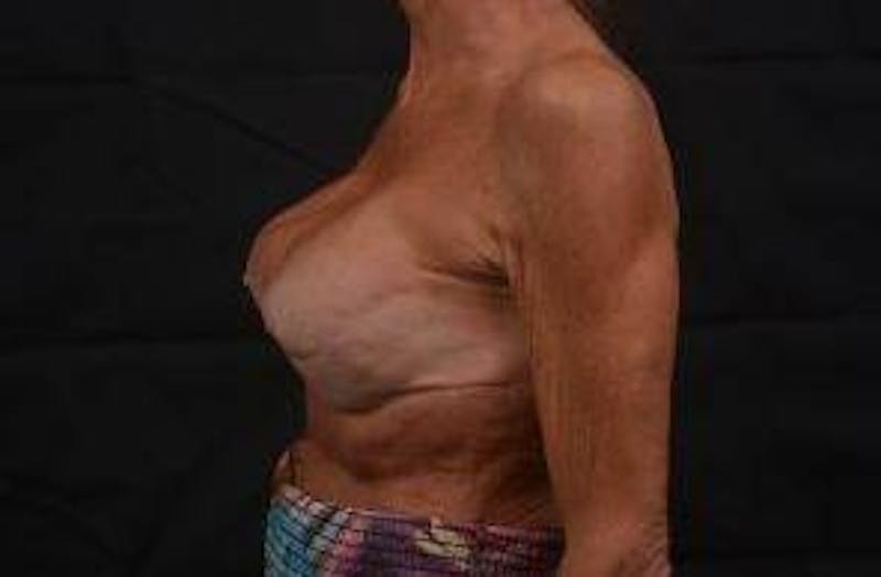 Aesthetic Breast Revision Before & After Gallery - Patient 903974 - Image 3