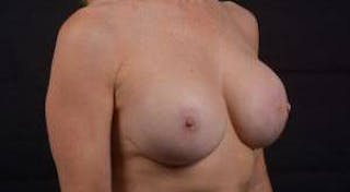 Reconstructive Breast Revision Before & After Gallery - Patient 122768 - Image 10