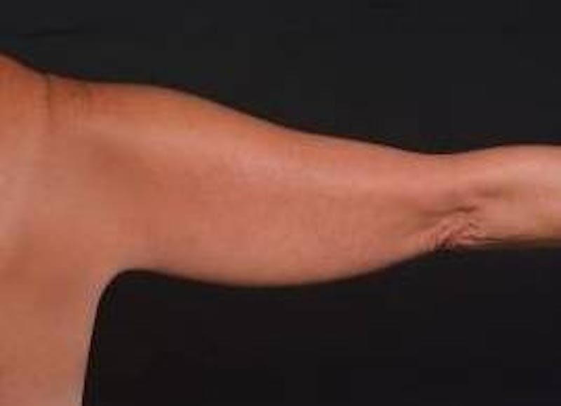 BodyTite Arms Before & After Gallery - Patient 386112 - Image 7