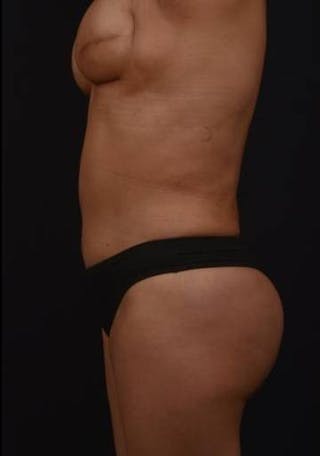 Brazillian Butt Lift Before & After Gallery - Patient 209829 - Image 6