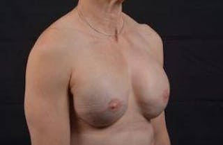 Immediate Breast Reconstruction – Skin Sparing Before & After Gallery - Patient 871817 - Image 10