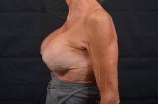 Aesthetic Breast Revision Before & After Gallery - Patient 903974 - Image 4