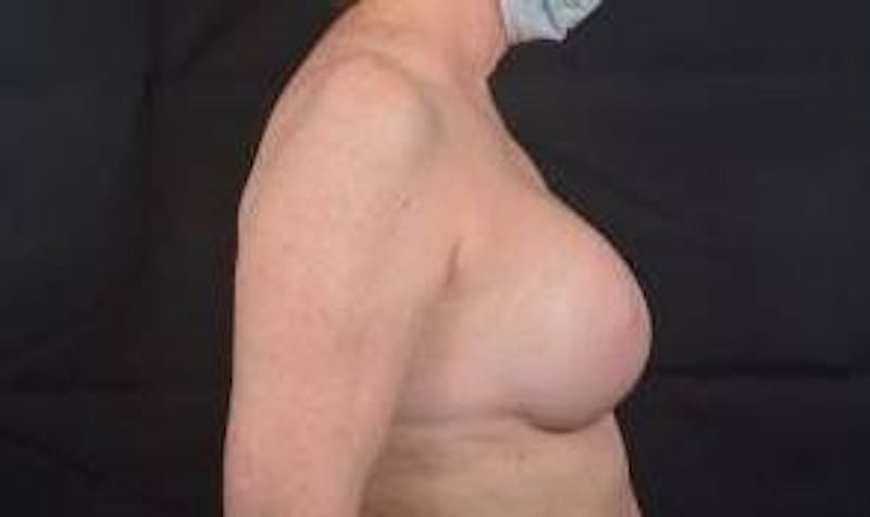Immediate Breast Reconstruction – Nipple Sparing Before & After Gallery - Patient 351464 - Image 6